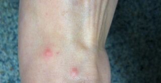 Chigger Bites on Ankles and Feet